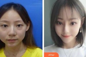 泰州麗都醫(yī)療美容醫(yī)院楊義整形價(jià)格表附美白貼片案例展示