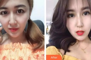 泰州愛(ài)爾眼科醫(yī)院葉楠整形價(jià)格表附激光去黑眼圈案例展示