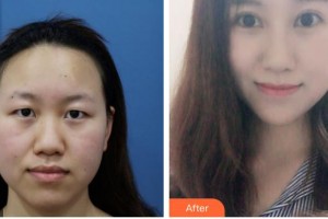 泰州麗都醫(yī)療美容醫(yī)院劉俠整形價(jià)格表附切開雙眼皮案例展示