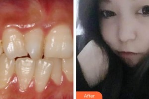 泰州玲瓏口腔門診部秦琳玲整形價(jià)格表附金屬托槽矯正案例展示