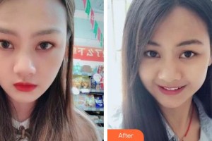 泰州拜博口腔醫(yī)院姜潤(rùn)整形價(jià)格表附牙齒隱形矯正案例展示