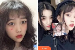 泰州拜博口腔醫(yī)院劉延峰整形價(jià)格表附牙齒隱形矯正案例展示