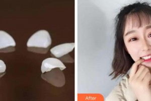 泰州拜博口腔醫(yī)院范琳琳整形價(jià)格表附美白貼片案例展示