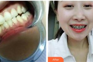 鎮(zhèn)江汪有國整形美容醫(yī)院汪有國整形價格表附牙齒陶瓷矯正案例展示