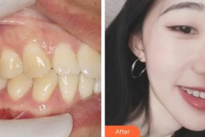 鎮(zhèn)江市第一人民醫(yī)院美容整形科徐斌整形價(jià)格表附牙齒隱形矯正案例展示