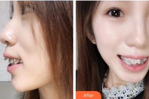 鎮(zhèn)江市第一人民醫(yī)院美容整形科王金龍住院醫(yī)師整形價(jià)格表附金屬托槽矯正案例展示