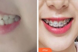 鎮(zhèn)江市第一人民醫(yī)院美容整形科嚴(yán)志新整形價(jià)格表附金屬托槽矯正案例展示