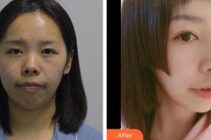 鎮(zhèn)江華美醫(yī)療美容門診部宋明義整形價(jià)格表附鼻部綜合案例展示