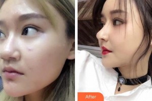 鎮(zhèn)江瑞麗醫(yī)療美容醫(yī)院端木雪峰整形價(jià)格表附鼻部綜合案例展示