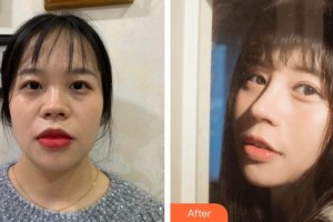 鎮(zhèn)江康復(fù)眼科醫(yī)院（鎮(zhèn)江市第—人民醫(yī)院眼科）張芹整形價(jià)格表附肋軟骨隆鼻案例展示