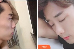 鎮(zhèn)江市第一人民醫(yī)院美容整形科王兵整形價格表附鼻部綜合案例展示