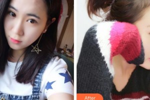 鎮(zhèn)江采薇整形美容醫(yī)院高思遠整形價格表附鼻中隔軟骨隆鼻案例展示