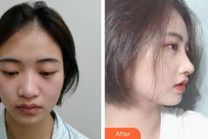 鎮(zhèn)江華儷醫(yī)療美容門診部王擊進整形價格表附肋軟骨隆鼻案例展示