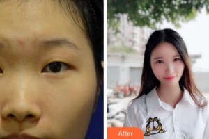 鎮(zhèn)江華儷醫(yī)療美容門診部鄭婷整形價格表附切開雙眼皮案例展示