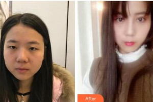 鎮(zhèn)江華儷醫(yī)療美容門診部戴星整形價格表附切開雙眼皮案例展示