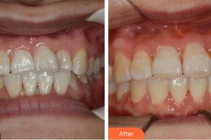 鎮(zhèn)江拜博口腔門診部李娜整形價格表附牙齒陶瓷矯正案例展示