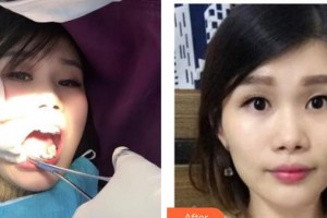 鎮(zhèn)江市口腔醫(yī)院劉振中整形價格表附金屬托槽矯正案例展示