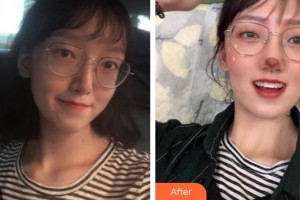 鎮(zhèn)江市口腔醫(yī)院朱鎮(zhèn)整形價格表附金屬托槽矯正案例展示