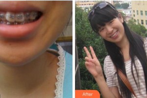 鎮(zhèn)江市口腔醫(yī)院顧紅政整形價格表附金屬托槽矯正案例展示