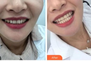 鎮(zhèn)江市口腔醫(yī)院韋愛君整形價格表附牙貼面案例展示