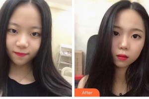 湘潭市中心醫(yī)院醫(yī)學整形美容科陳婷婷整形價格表附鼻部綜合案例展示