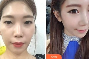 湘潭市中心醫(yī)院醫(yī)學整形美容科李志剛整形價格表附鼻部綜合案例展示