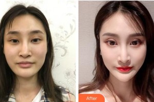 湘潭雅美醫(yī)療美容醫(yī)院何敏整形價格表附墊鼻基底案例展示