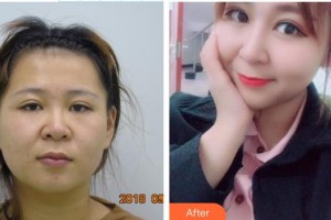 湘潭市中心醫(yī)院醫(yī)學整形美容科肖學敏住院醫(yī)師整形價格表附鼻部綜合案例展示