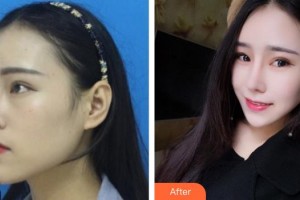 湘潭市紅十字仁和醫(yī)院整形美容中心宋蕾整形價格表附鼻部綜合案例展示