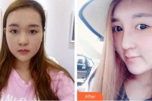 湘潭華美整形醫(yī)院張勝昌整形價(jià)格表附鼻部綜合案例展示