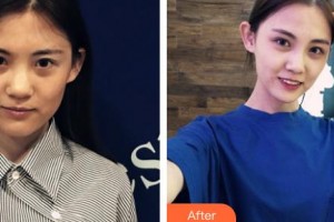 湘潭華美整形醫(yī)院劉攀整形價格表附鼻部綜合案例展示