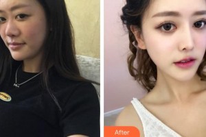 湘潭華美整形醫(yī)院賓仁整形價格表附鼻部綜合案例展示