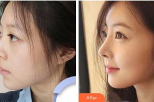 湘潭顧維新醫(yī)療美容診所顧維新整形價格表附假體隆鼻案例展示