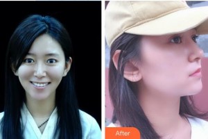 湘潭雅美醫(yī)療美容醫(yī)院鄭敏敏整形價格表附鼻部綜合案例展示