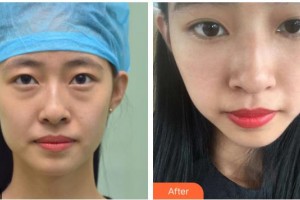 湘潭愛爾眼科醫(yī)院李仁華整形價格表附內切祛眼袋案例展示