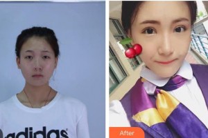 湘潭愛爾眼科醫(yī)院毛安真整形價格表附眼部整形案例展示