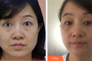 永州星雅醫(yī)療美容門診部譚超整形價格表附激光去黑眼圈案例展示