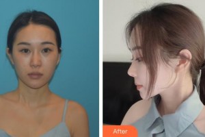 永州博美整形美容醫(yī)院陳璋整形價格表附肋軟骨隆鼻案例展示