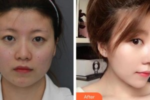 永州新唯美整形美容醫(yī)院劉曉紅整形價格表附鼻部綜合案例展示