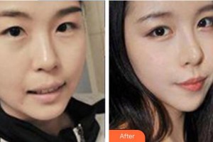 永州佳美醫(yī)學(xué)整形美容醫(yī)院黃南儒整形價格表附假體隆鼻案例展示