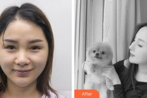 永州新唯美整形美容醫(yī)院陳文可整形價格表附肋軟骨隆鼻案例展示