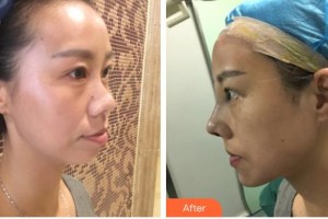 永州市皮膚病醫(yī)院醫(yī)療美容科艾玲玲整形價格表附	項目分類	鼻部整形案例展示