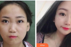 永州市皮膚病醫(yī)院醫(yī)療美容科蔣楊整形價格表附鼻部綜合案例展示