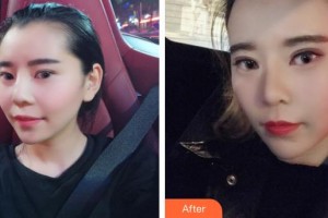 永州市皮膚病醫(yī)院醫(yī)療美容科伍美云整形價格表附鼻部綜合案例展示