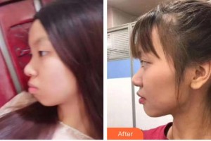 永州中南口腔醫(yī)院丁嵐整形價格表附金屬托槽矯正案例展示