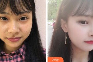 永州愛爾眼科醫(yī)院唐勛倫整形價格表附埋線雙眼皮案例展示