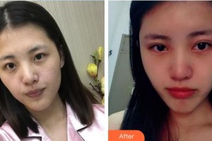 永州愛爾眼科醫(yī)院李玉婷整形價格表附切開雙眼皮案例展示