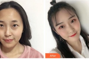 永州愛爾眼科醫(yī)院雷林國整形價格表附切開雙眼皮案例展示