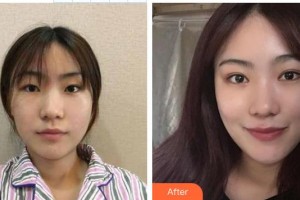 永州市第一人民醫(yī)院眼科趙永旺整形價格表附切開雙眼皮案例展示