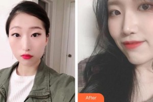 永州愛爾眼科醫(yī)院陳艷文整形價格表附眼部綜合案例展示